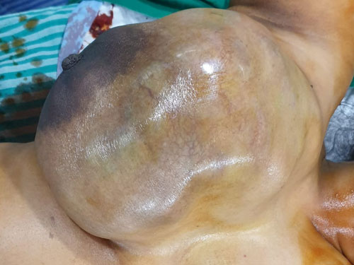 Giant Fibroadenoma of Right Breast