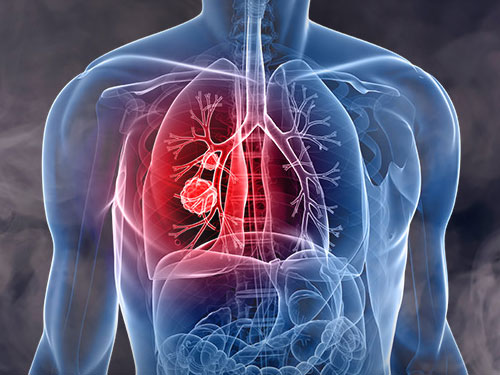 പുകയുന്ന അർബുദം (Lung Cancer)
