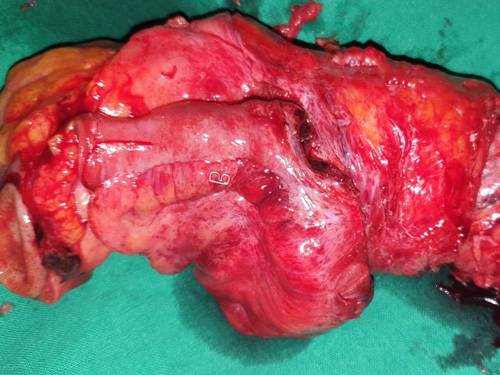 Radical resection of Rectal cancer